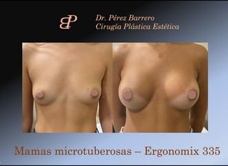 Aumento de pecho - Dr. Pérez Barrero