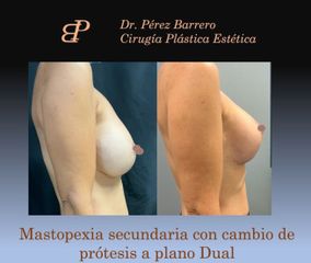 Mastopexia - Dr. Pérez Barrero
