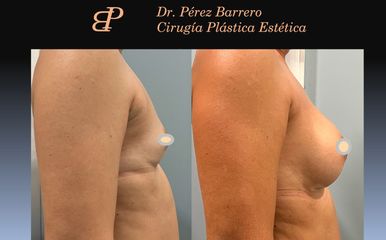 Aumento de pecho - Dr. Pérez Barrero