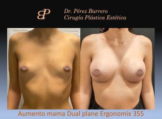 Aumento de pecho - Dr. Pérez Barrero