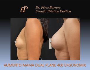Aumento de pecho - Dr. Pérez Barrero