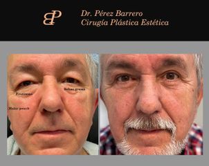 Blefaroplastia - Dr. Pérez Barrero
