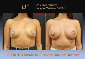 Aumento de pecho - Dr. Pérez Barrero