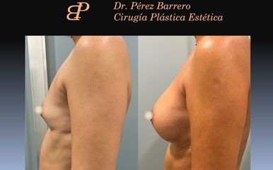 Aumento de pecho - Dr. Pérez Barrero