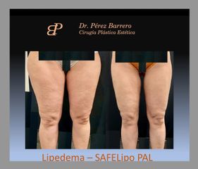 Liposucción - Dr. Pérez Barrero