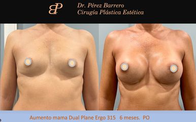 Aumento de pecho - Dr. Pérez Barrero