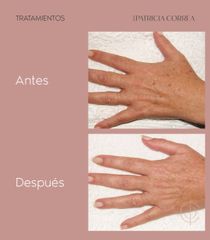 Tratamiento antimanchas - Dra. Patricia Correa