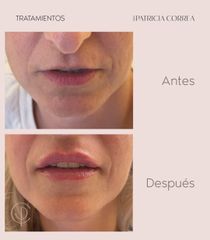 Aumento de labios - Dra. Patricia Correa