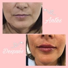 Aumento de labios y relleno de surco nasogeniano - Dra. Patricia Correa