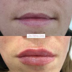 Aumento de labios - Dra. Patricia Correa