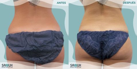 Criolipólisis - Clínica Sanux