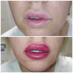 Aumento de labios - Clínica Sanux