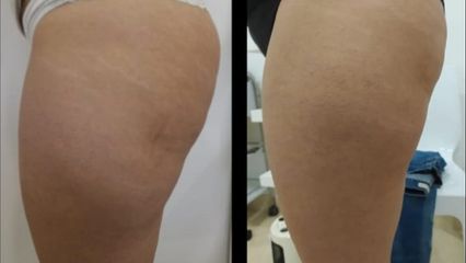 Celulitis - Clínica Sanux