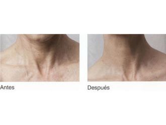 Mesoterapia - 629626