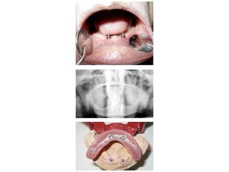 Implantes dentales - 789829