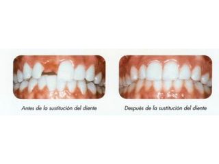 Implantes dentales - Dr. Carlos Miera