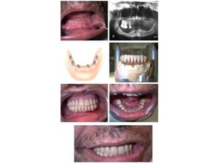 Implantes dentales - Dr. Carlos Miera