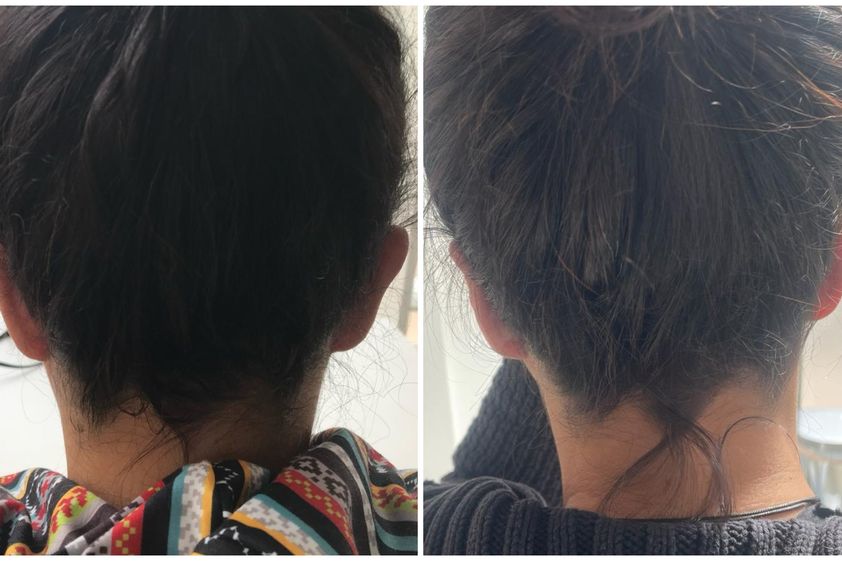 Otoplastia antes y después - 862211