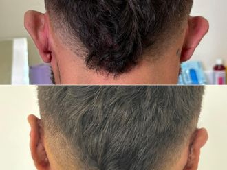 Otoplastia antes y después - 872039