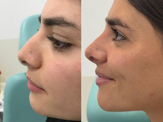 Rinoplastia antes y después - 876734