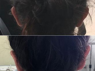 Otoplastia antes y después - 876735