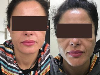 Otoplastia antes y después - 876736