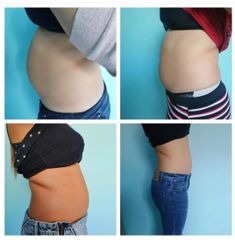 Recuperación postparto - Fisioterapia Keops