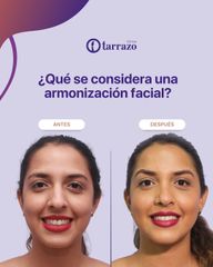 Armonización facial - Clínica Tarrazo