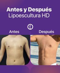 Lipoescultura HD - Clínica Tarrazo
