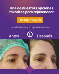 Blefaroplastia - Clínica Tarrazo