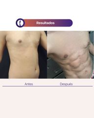 Marcación Abdominal - Clínica Tarrazo