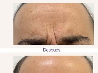 Eliminación arrugas antes y después - 878475