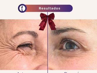 Eliminación arrugas antes y después - 878476