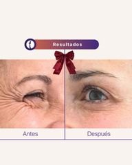 Eliminación de arrugas