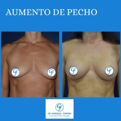 Cirugía de pecho - Dr. Gonzalez-Fontana