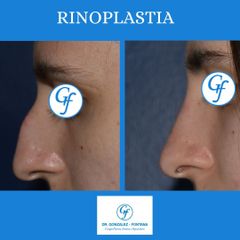 Rinoplastia - Dr. Gonzalez-Fontana