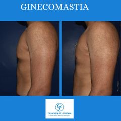 Ginecomastia - Dr. Gonzalez-Fontana