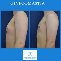 Ginecomastia - Dr. Gonzalez-Fontana