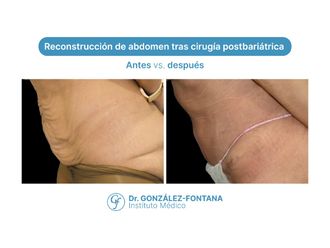 Abdominoplastia antes y después - 870669