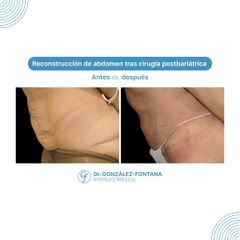 Abdominoplastia - Dr. Gonzalez-Fontana