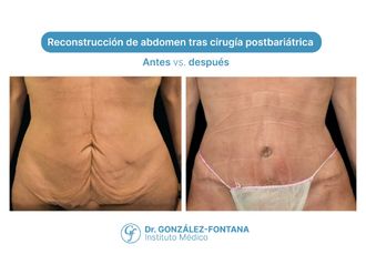 Abdominoplastia antes y después - 870670