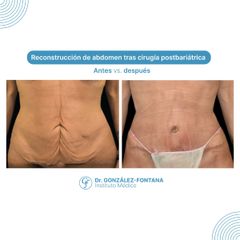 Abdominoplastia - Dr. Gonzalez-Fontana