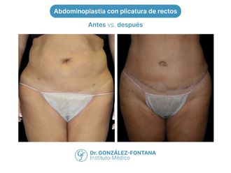 Abdominoplastia antes y después - 870671