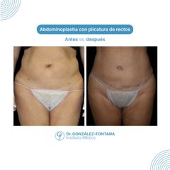 Abdominoplastia - Dr. Gonzalez-Fontana