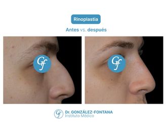 Rinoplastia antes y después - 870672