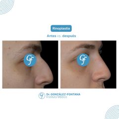 Septorinoplastia - Dr. Gonzalez-Fontana