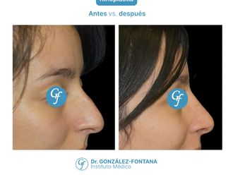 Rinoplastia antes y después - 870673