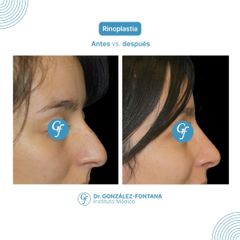 Septorinoplastia - Dr. Gonzalez-Fontana