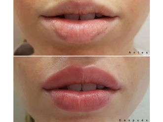 Aumento labios - 627893