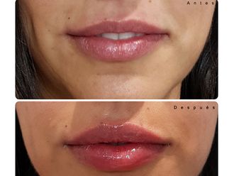 Aumento labios - 632108